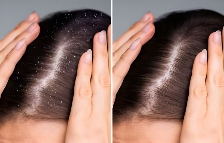 17 Cara Mengatasi Ketombe Parah, Coba di Rumah! - Nia Hair Extensions